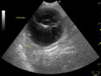胆嚢粘液嚢腫の超音波検査所見