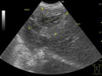肝腫瘍の超音波検査所見