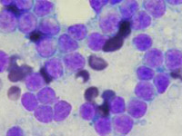 リンパ腫細胞診