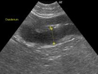 消化器型リンパ腫の超音波検査所見(腸管の肥厚、層構造不明瞭)
