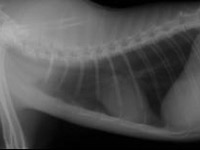 前縦隔型リンパ腫(治療後)