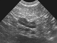 超音波検査(左副腎)